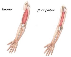 Distrofie musculară la nou-născuți și copii mici, foto, tratament