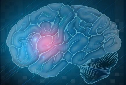Brain după accident vascular cerebral - consecințe ale tulburărilor circulatorii