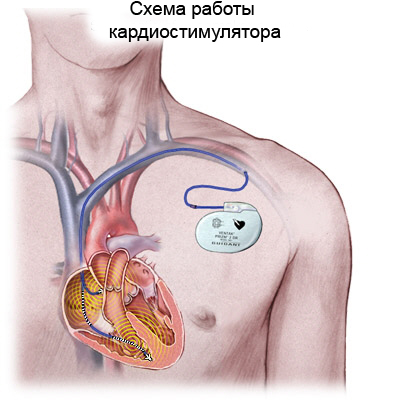 Tulburări ale ritmului cardiac, tratament