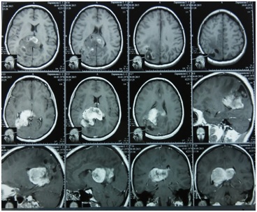 Neurochirurgia tumorilor cerebrale