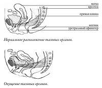 Omiterea a uterului - cauze, simptome și semne, tratament, comentarii, modul de a trata prolaps de col uterin, fara