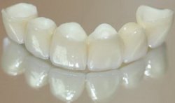 Основні види штучних зубних коронок, штучні зубні коронки