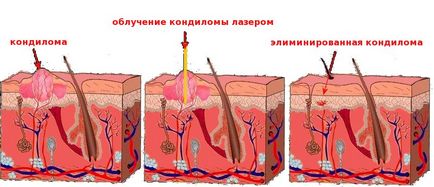 Гострі кондиломи в піхву методи видалення