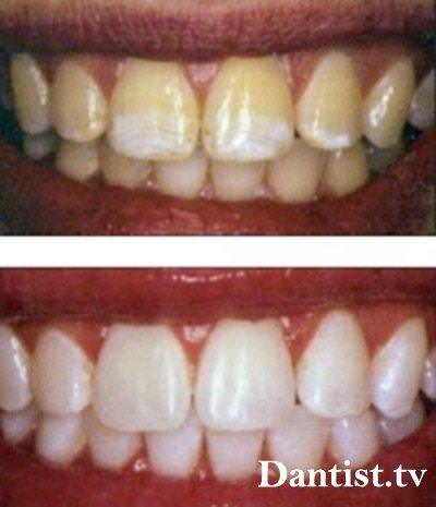 Відбілювання зубів crest whitestrips ціна і фото