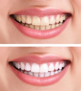 Відбілювання зубів за вигідною ціною, клініка стоматології - академія посмішки - в Нижньому Новгороді