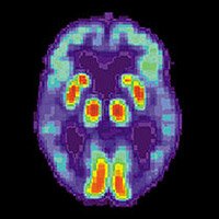 Відкрита причина «хвороби Альцгеймера» - саморозвиток і самовдосконалення езотерика, особистісний