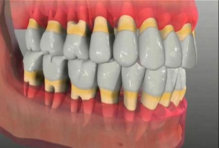 Пародонтоза причините и симптомите, диагностициране, лечение и профилактика, популярна медицина