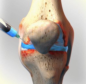 Artroza patellofemorală a articulației genunchiului și gradul de profilaxie