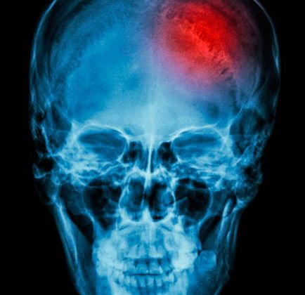 Перелом черепа у дитини симптоми, причини і наслідки