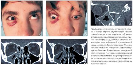 Перелом очниці (орбіти очі) наслідки, лікування, причини