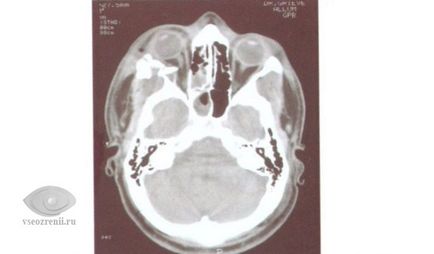 Fractura peretilor de pe orbita