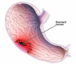 Tranziția ulcerului la stomac în cancer