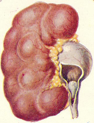 Pyloectazia rinichiului - cât de periculoasă este