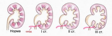 Pyloectazia rinichiului - cât de periculoasă este