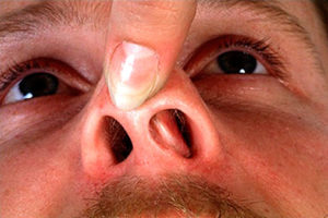 Повторна ринопластика коли можна робити, складності, асиметрія кінчика носа