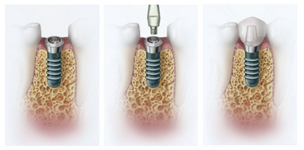 Avantajele implantării, centrul stomatologiei