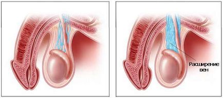 Причини розвитку варикоцеле