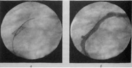 Principiile tratamentului chirurgical al ibs