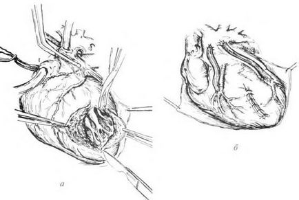 Principiile tratamentului chirurgical al ibs