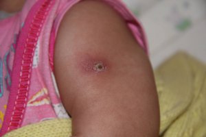 Vaccinarea btszh - totul despre sarcină