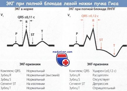 Semne de blocare completă a piciorului stâng al fasciculului fasciculului (pnpg) pe eq