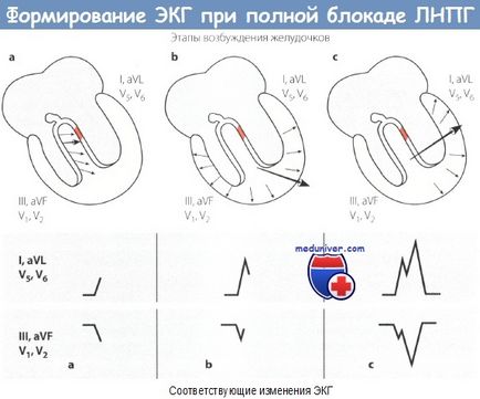 Ознаки повної блокади лівої ніжки пучка Гіса (ПНПГ) на ЕКГ