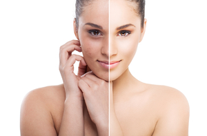 Peeling profesional - această metodă este eficientă pentru a îmbunătăți pielea feței