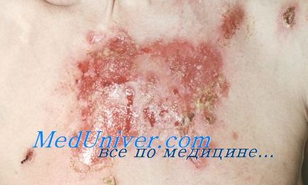 Simple epidermolysis bulo (pbe) - diagnostic, tratament