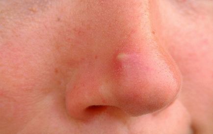 Простудні прищі на обличчі - причини, як позбутися, як позбутися від прищів, засіб від прищів