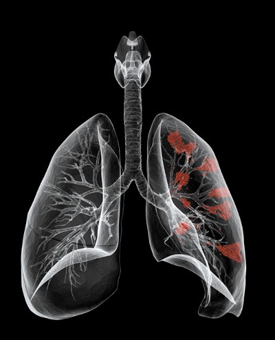 Cancerul pulmonar