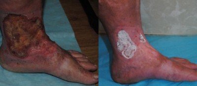 Agenți de vindecare a rănilor de unguent de la nivelul extremităților inferioare de la ulcerul trofic pe picioare