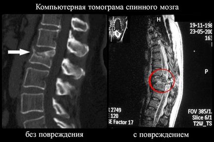 Ruptura măduvei spinării, dacă este posibil să se ridice, consecințele și recuperarea
