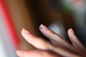Moalele de pe degetele mâinii sunt dăunătoare sănătății pielii