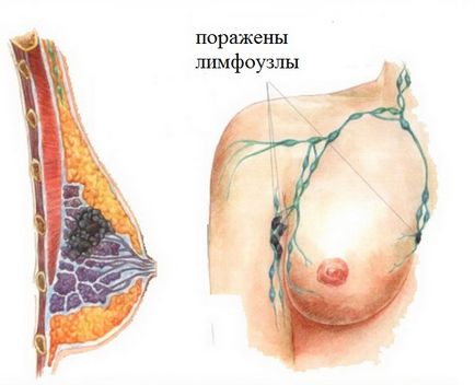 Sarcina sanilor - tratament modern în străinătate