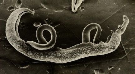 Schistosomiasis simptome și tratament la om