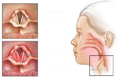Simptomele laringospasmului la copii și adulți, prim ajutor, tratament, cauze