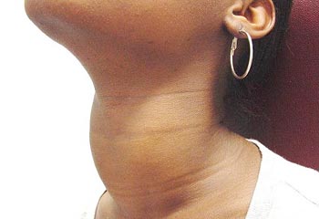 Simptomele gurii nodulare a glandei tiroide