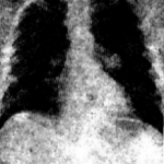 A tünetek a tüdőgyulladás tünetei tüdőgyulladás serdülők 14 és 15 éves, a terápia