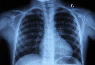 Симптоми запалення легенів у підлітків ознаки пневмонії в 14 і 15 років, лікування