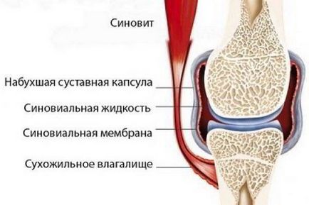 Sinovita articulației articulare Simptome, diagnostic și tratament