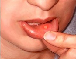 Stomatitis gyermekeknél, tünetei stomatitis gyermekeknél