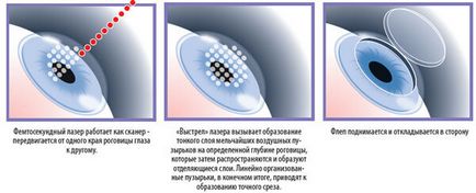 Super lasik - trăsături ale metodei de corectare a vederii