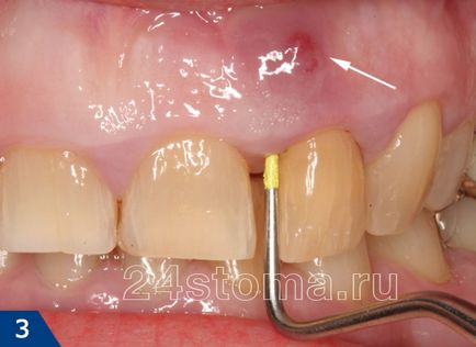 Fistula pe gingiile etape de tratament, sfaturi de specialiști