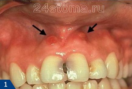 Fistula pe gingiile etape de tratament, sfaturi de specialiști