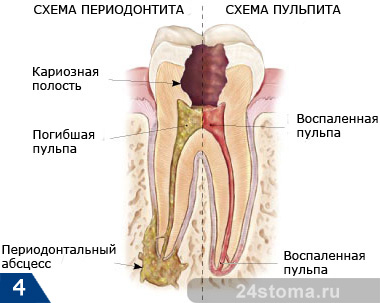 Свищ на яснах етапи лікування, поради фахівців