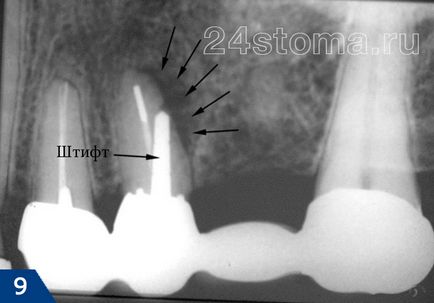 Fistula pe gingiile etape de tratament, sfaturi de specialiști