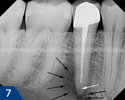 Fistula pe gingiile etape de tratament, sfaturi de specialiști