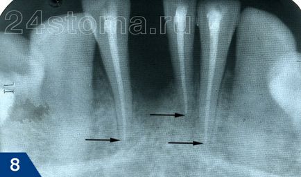 Fistula pe gingiile etape de tratament, sfaturi de specialiști