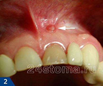 Fistula pe gingiile etape de tratament, sfaturi de specialiști