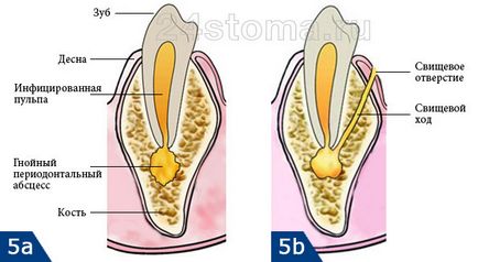 Fistula pe gingiile etape de tratament, sfaturi de specialiști